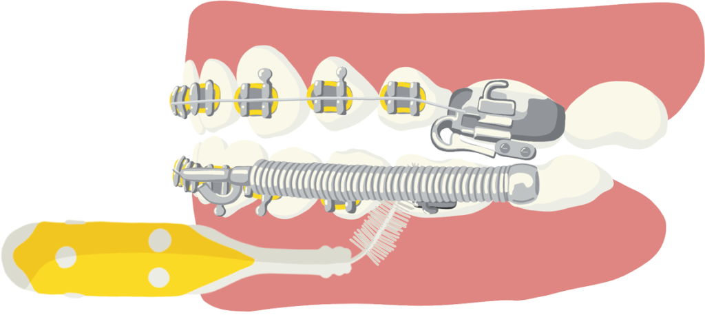 Brossage appareil ressort propulseur avec la brossette