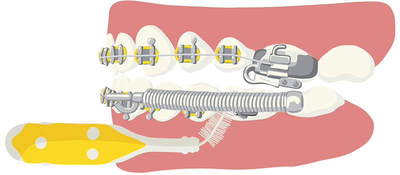 Illustration de la brossette qui nettoie l'appareil ressort propulseur du cabinet Dentel à Lannion.