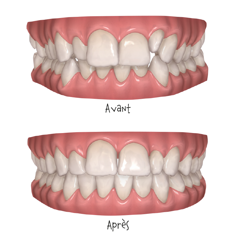 Illustration, avant/après des aoligneurs du cabinet Dentel à Lannion.