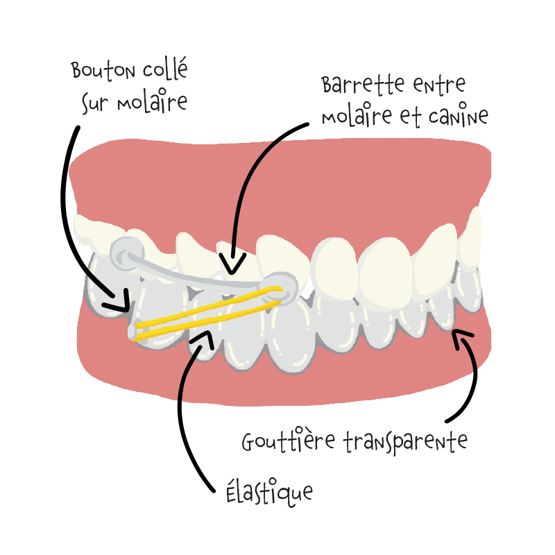 Illustration, schéma de l'appareil Carrière Motion® du cabinet Dentel à Lannion.